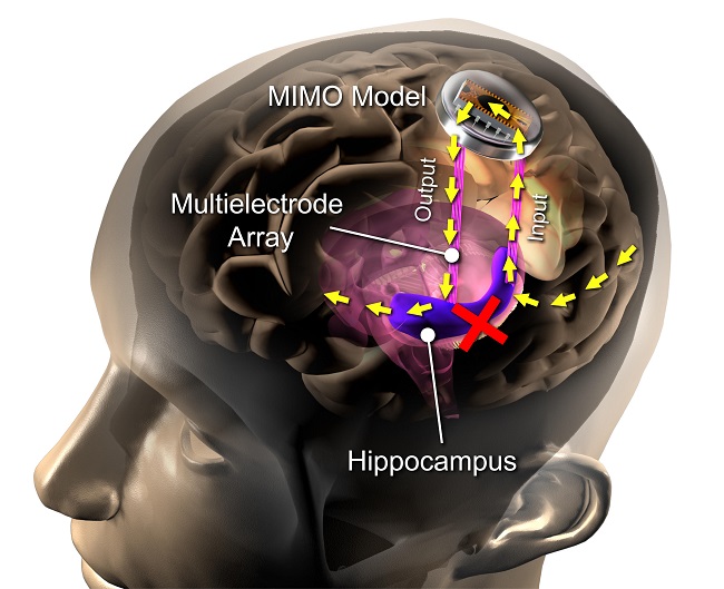 cerveau implant puce